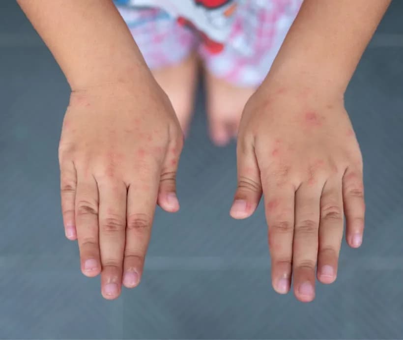 Czy cynamon uczula dzieci? Objawy alergii, które musisz znać Czy cynamon uczula dzieci? Objawy alergii, które musisz znać