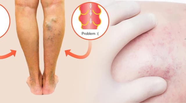 Jakie leki na zakrzepicę nóg pomogą uniknąć powikłań? Jakie leki na zakrzepicę nóg pomogą uniknąć powikłań?