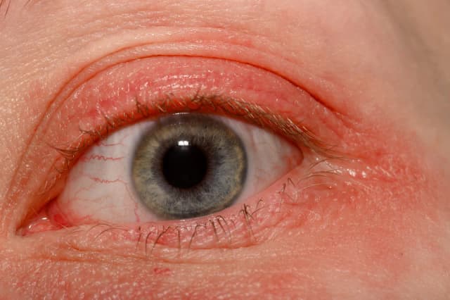 Czy klej do rzęs uczula? Objawy alergii i jak ich unikać Czy klej do rzęs uczula? Objawy alergii i jak ich unikać