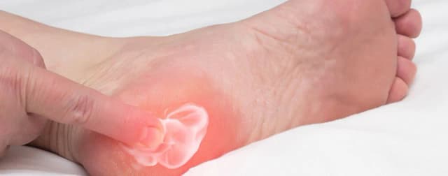 Jakie leki na ostrogę piętową pomogą w bólu i zapaleniu? Jakie leki na ostrogę piętową pomogą w bólu i zapaleniu?