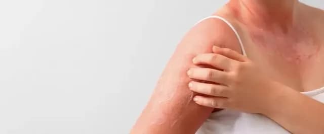 Skuteczne leki na alergię na słońce – ulga w objawach i ochrona Skuteczne leki na alergię na słońce – ulga w objawach i ochrona