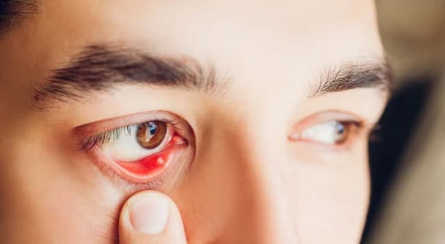 Skuteczne leki na jęczmień, które szybko przyniosą ulgę Skuteczne leki na jęczmień, które szybko przyniosą ulgę