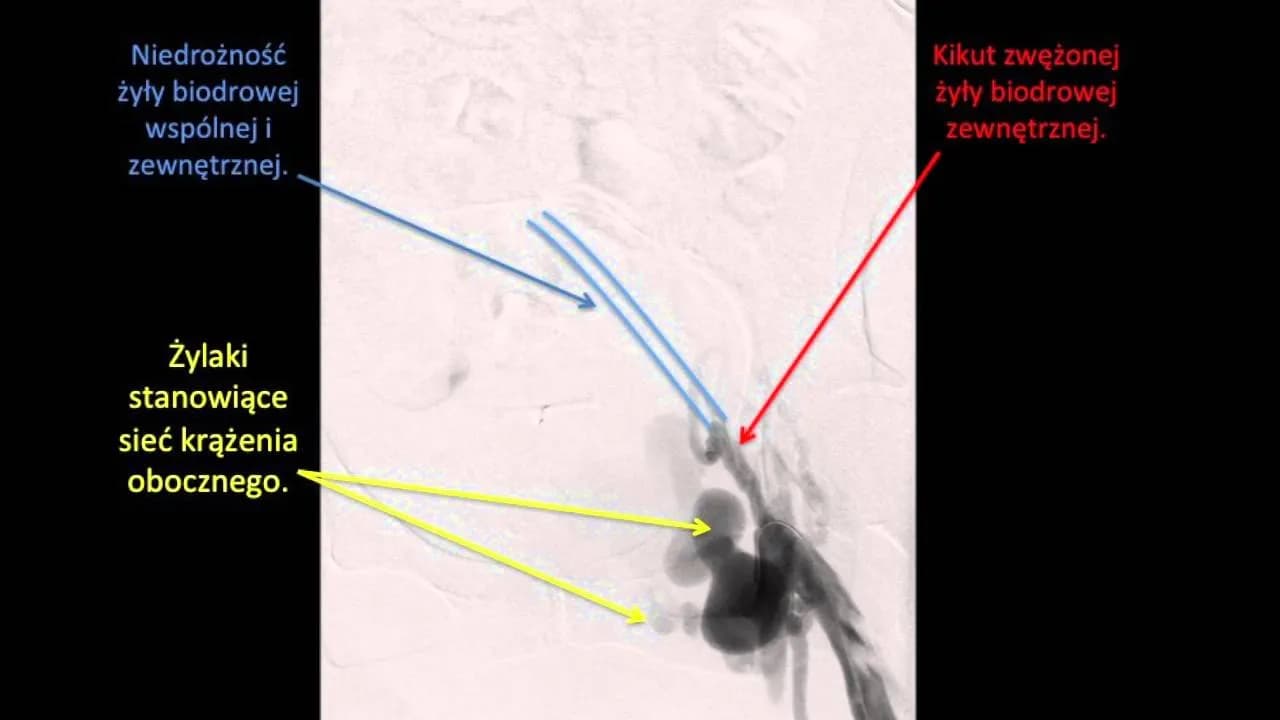 Niedrożność tętnicy biodrowej objawy: jak rozpoznać i leczyć? Niedrożność tętnicy biodrowej objawy: jak rozpoznać i leczyć?