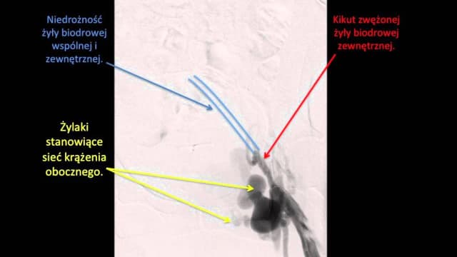 Niedrożność tętnicy biodrowej objawy: jak rozpoznać i leczyć? Niedrożność tętnicy biodrowej objawy: jak rozpoznać i leczyć?