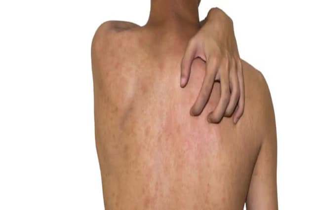 Czy kurkuma uczula? Objawy alergii i ryzyko reakcji alergicznych Czy kurkuma uczula? Objawy alergii i ryzyko reakcji alergicznych