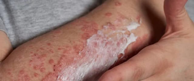 Czy cynk uczula? Objawy alergii i co robić w przypadku reakcji Czy cynk uczula? Objawy alergii i co robić w przypadku reakcji