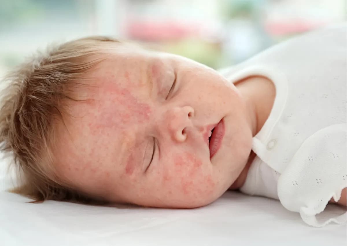 Alergia na mleko modyfikowane objawy – jak je rozpoznać i unikać? Alergia na mleko modyfikowane objawy – jak je rozpoznać i unikać?