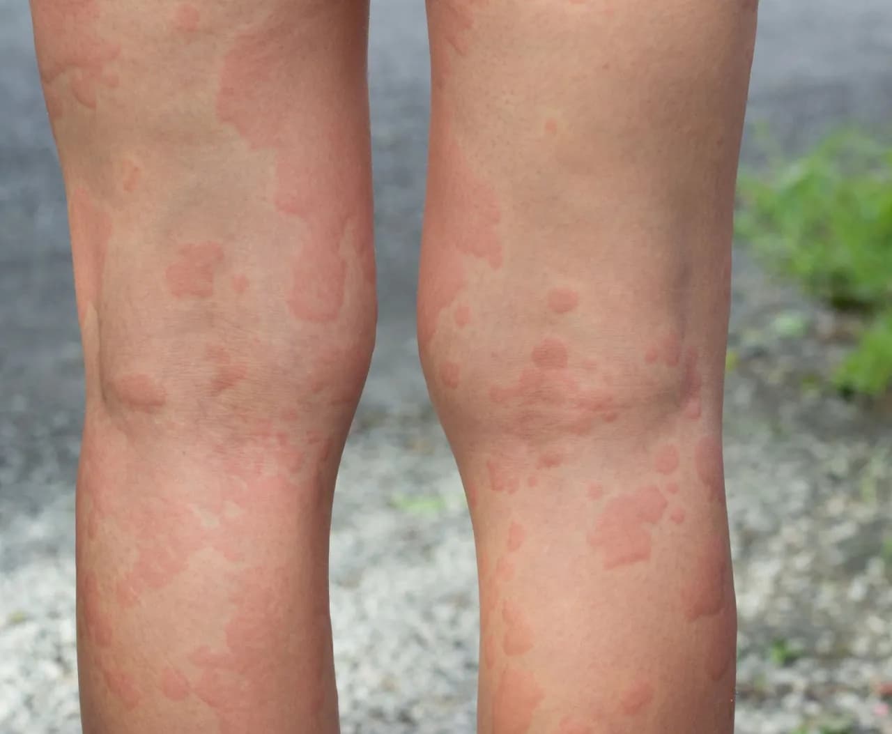 Alergia na słońce objawy: Zobacz, jak rozpoznać niebezpieczne reakcje Alergia na słońce objawy: Zobacz, jak rozpoznać niebezpieczne reakcje