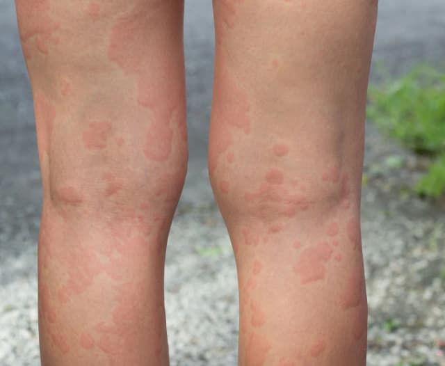 Alergia na słońce objawy: Zobacz, jak rozpoznać niebezpieczne reakcje Alergia na słońce objawy: Zobacz, jak rozpoznać niebezpieczne reakcje