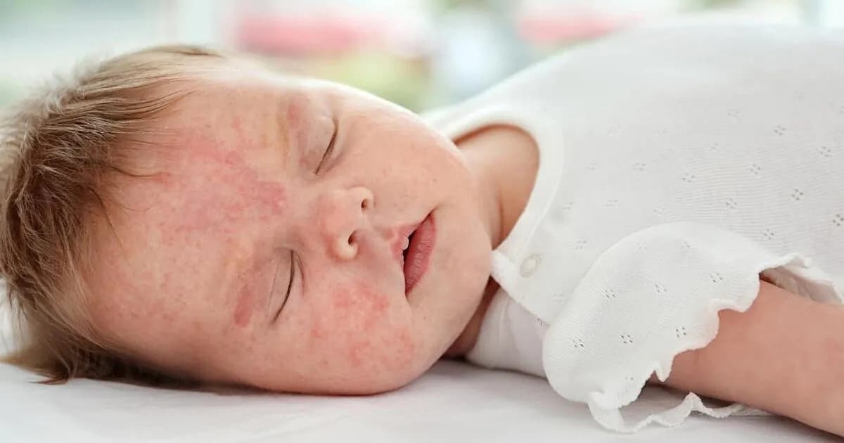 Czy witamina D3 może uczulać? Rzadkie reakcje alergiczne u dzieci Czy witamina D3 może uczulać? Rzadkie reakcje alergiczne u dzieci