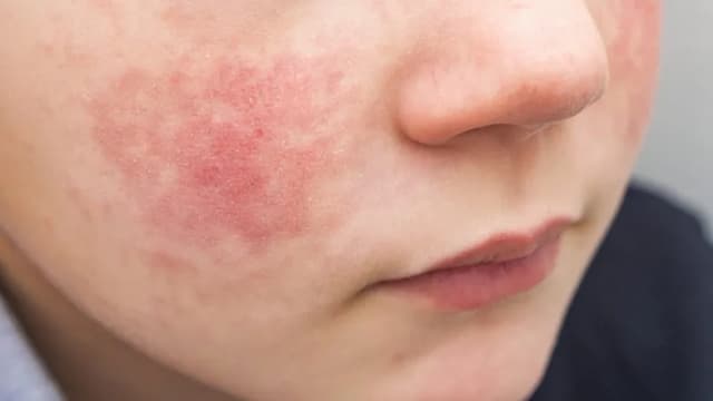 Jak wygląda alergia? Objawy i zmiany skórne, które musisz znać Jak wygląda alergia? Objawy i zmiany skórne, które musisz znać