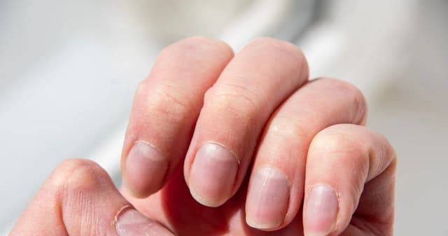 Niski poziom żelaza we krwi objawy – jak je rozpoznać i co zrobić Niski poziom żelaza we krwi objawy – jak je rozpoznać i co zrobić