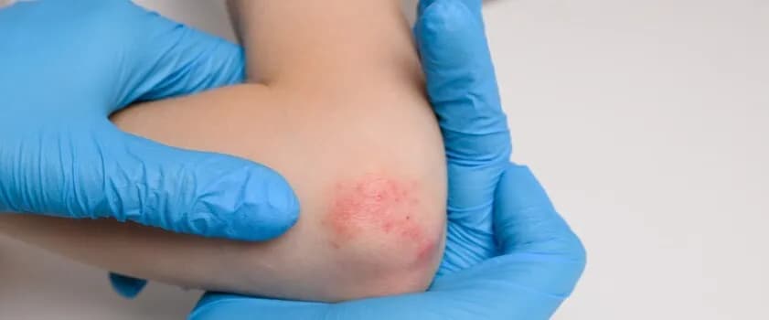 Alergia na konserwanty objawy: Jak rozpoznać niebezpieczne reakcje Alergia na konserwanty objawy: Jak rozpoznać niebezpieczne reakcje