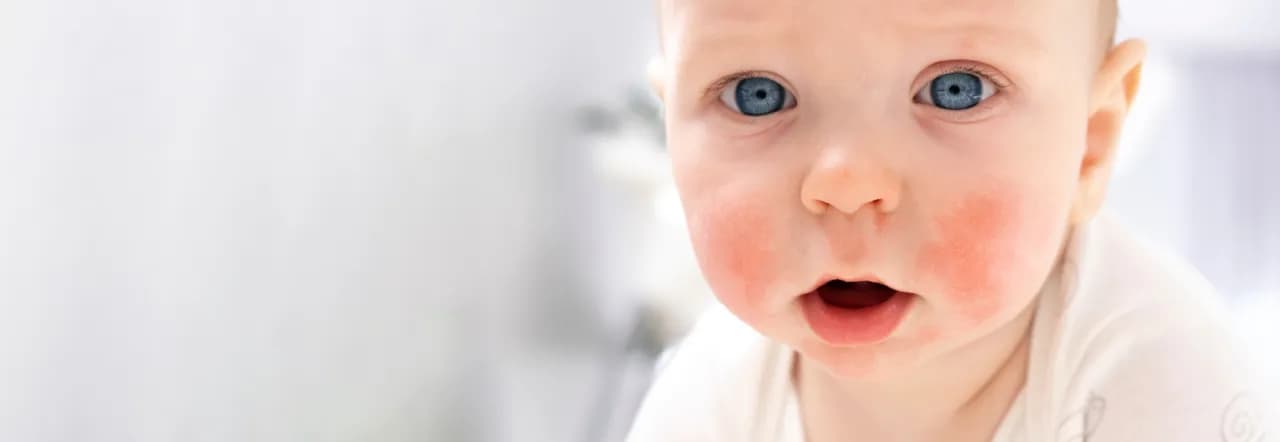 Czy burak uczula? Objawy alergii i co warto wiedzieć o ryzyku Czy burak uczula? Objawy alergii i co warto wiedzieć o ryzyku