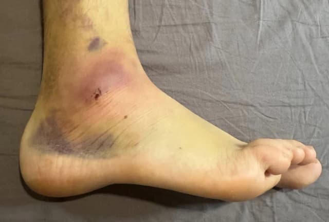 Skręcona kostka objawy: jak rozpoznać i co robić w przypadku urazu Skręcona kostka objawy: jak rozpoznać i co robić w przypadku urazu