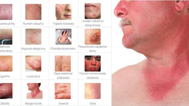 Jak wygląda alergia skórna zdjęcia – poznaj objawy i ich wygląd Jak wygląda alergia skórna zdjęcia – poznaj objawy i ich wygląd