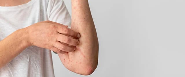 Czy biotyna uczula? Objawy alergii, które warto znać Czy biotyna uczula? Objawy alergii, które warto znać