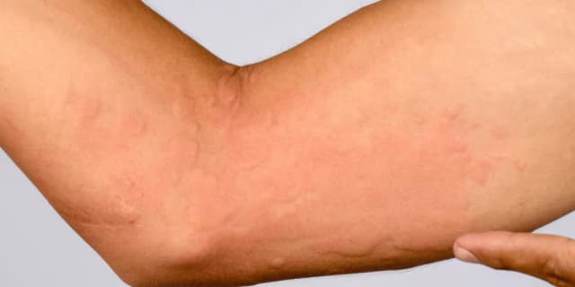 Czy brzoza uczula? Objawy alergii i jak ich unikać w sezonie pylenia Czy brzoza uczula? Objawy alergii i jak ich unikać w sezonie pylenia