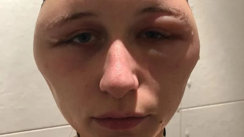 Alergia na farby do włosów objawy - jak uniknąć niebezpiecznych reakcji Alergia na farby do włosów objawy - jak uniknąć niebezpiecznych reakcji