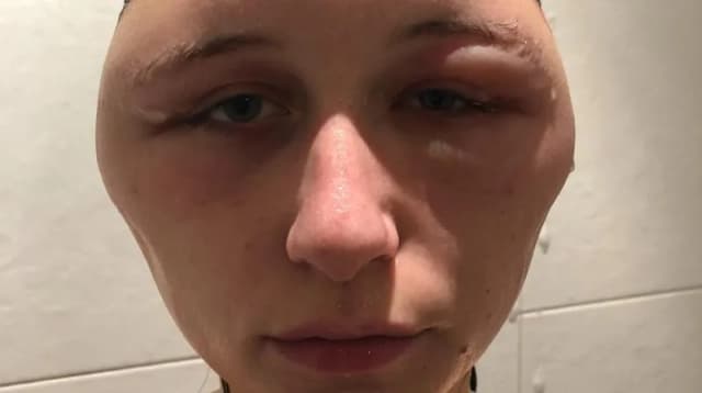 Alergia na farby do włosów objawy - jak uniknąć niebezpiecznych reakcji Alergia na farby do włosów objawy - jak uniknąć niebezpiecznych reakcji